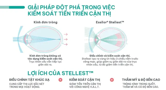 Giải pháp đột phá trong kiểm soát cận thị của Stellest